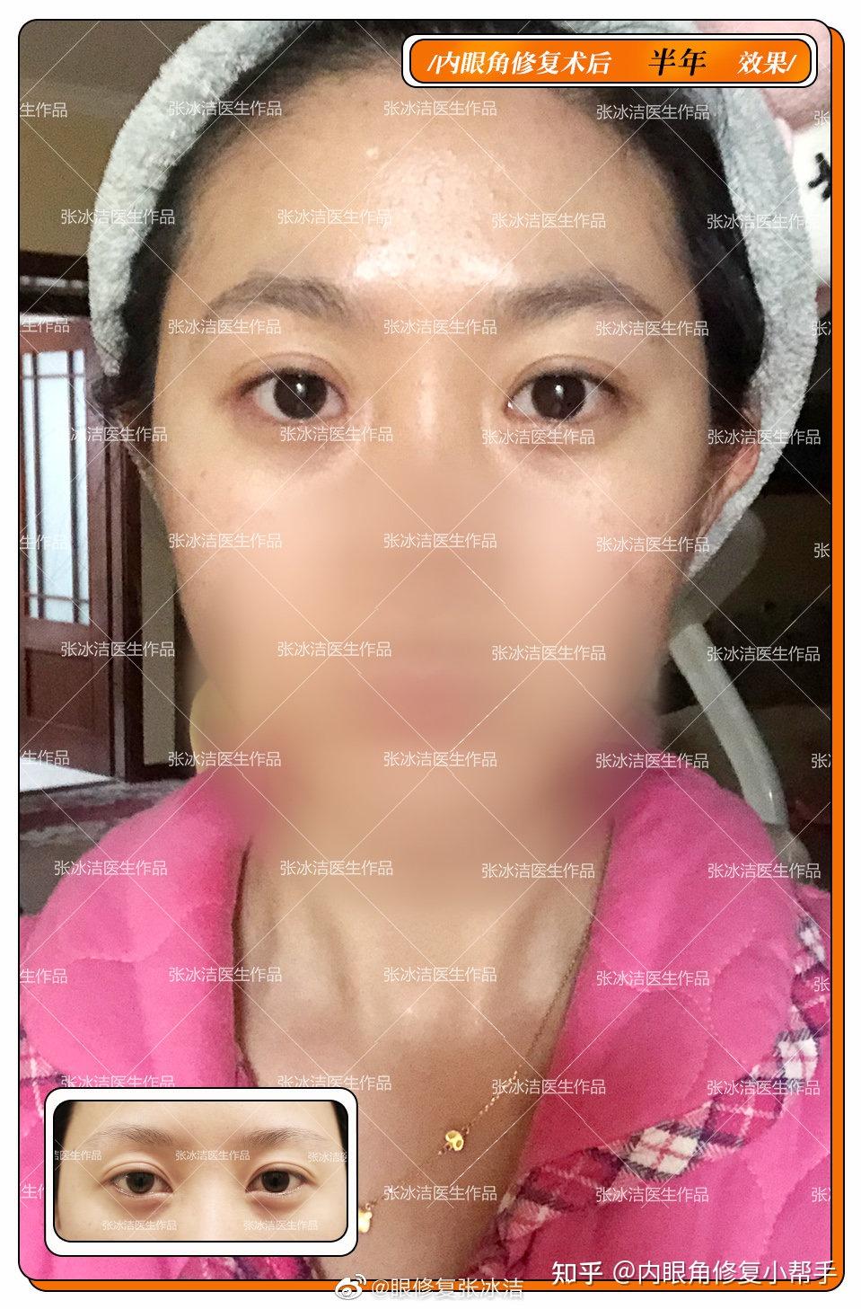 张冰洁内眼角修复对比案例丨内眼角开的过大