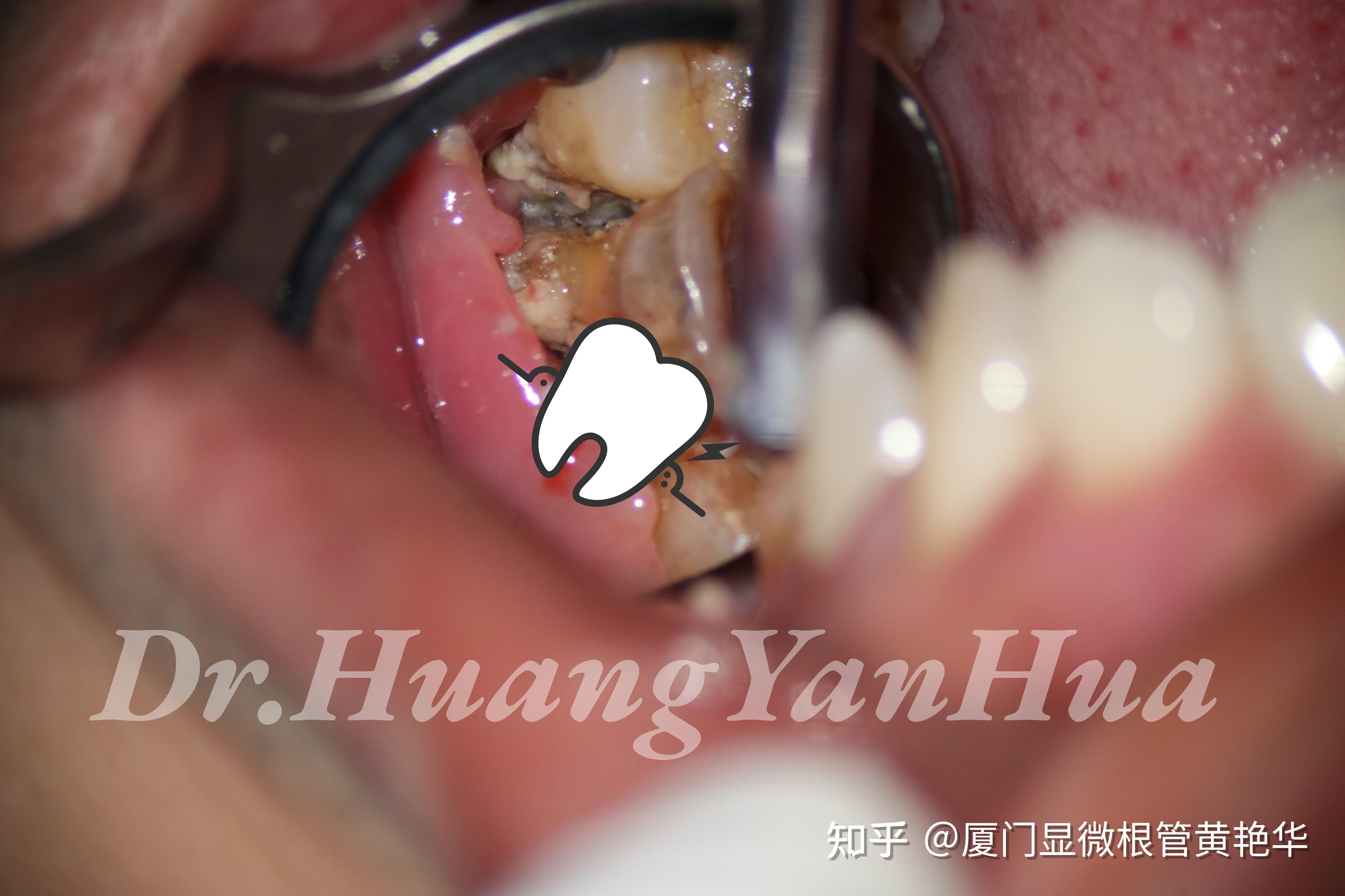 牙周袋深出血——中度牙周炎龈下刮治一例