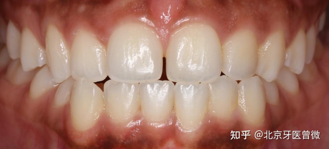 对刃关系导致的牙齿反颌(地包天),金属托槽不拔牙矫治