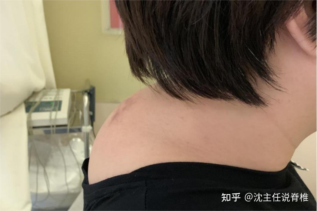 产后妈妈脖子为何会长"富贵包"呢?