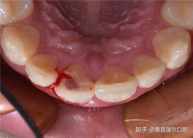 前口内牙像检查:11牙体折断2/3,牙髓暴露,叩不适,松动1度,牙龈红肿
