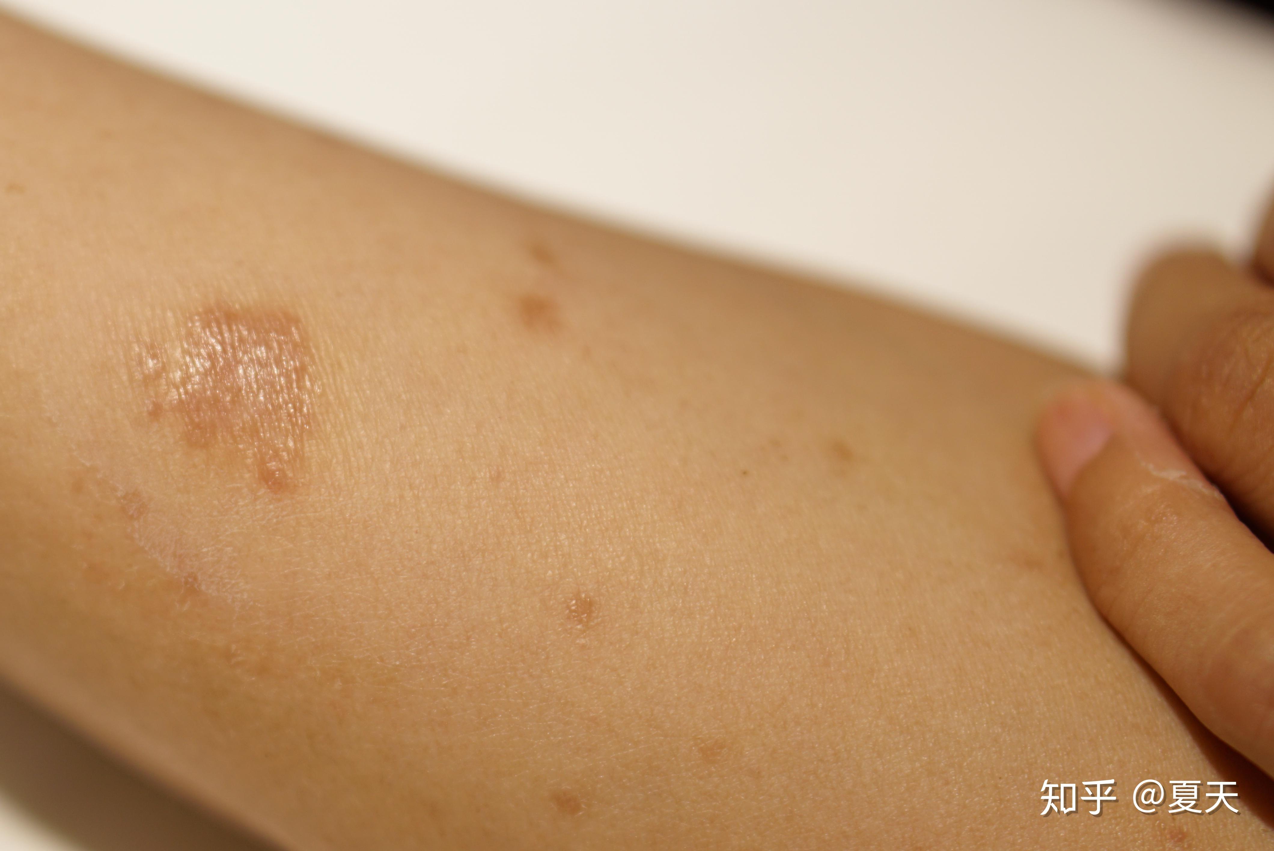 奇痒无比的湿疹治疗历程