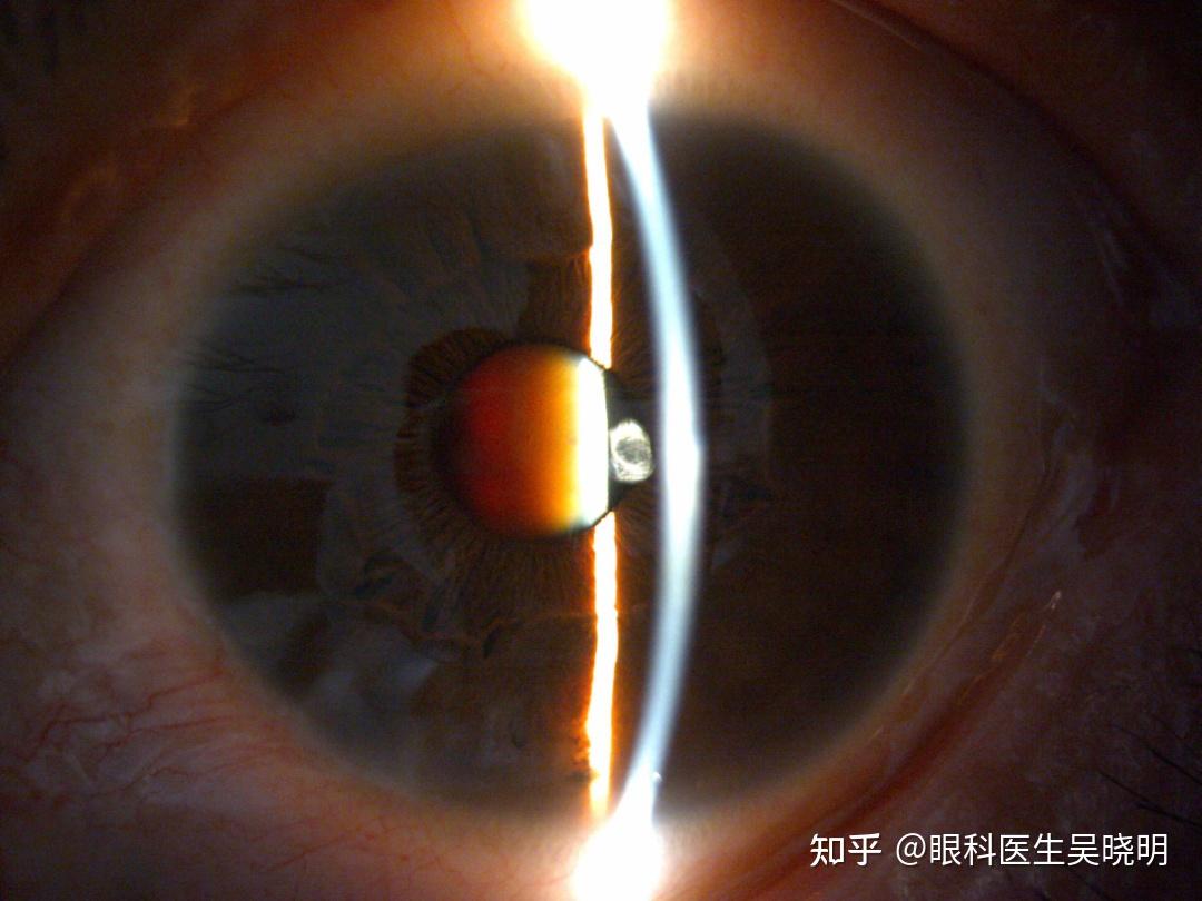 国内首批!吴晓明专家团队新开展miloop辅助的白内障超声乳化手术