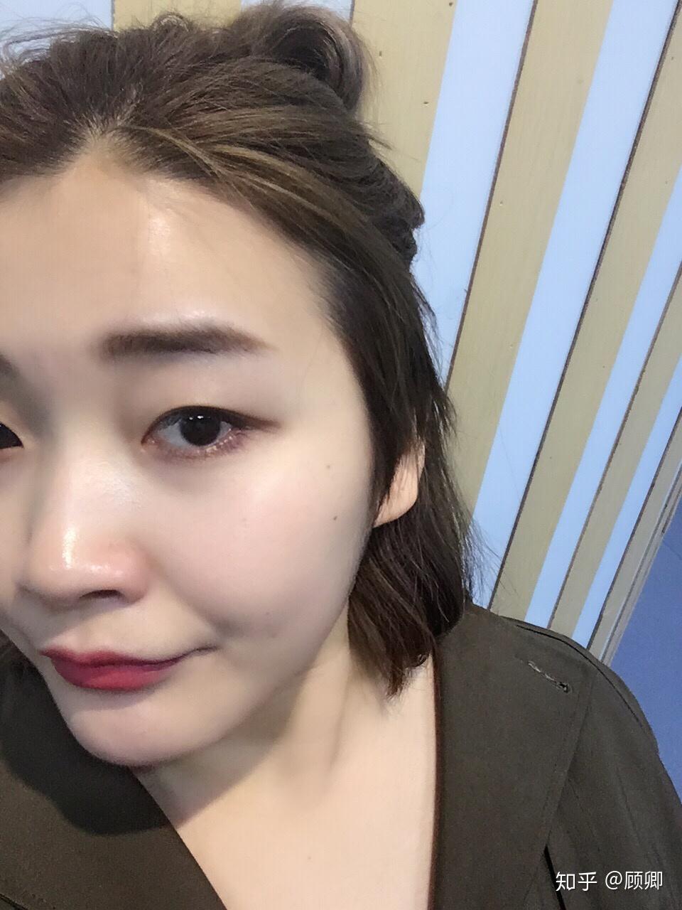 怎么去雀斑,激光祛斑怎么样?