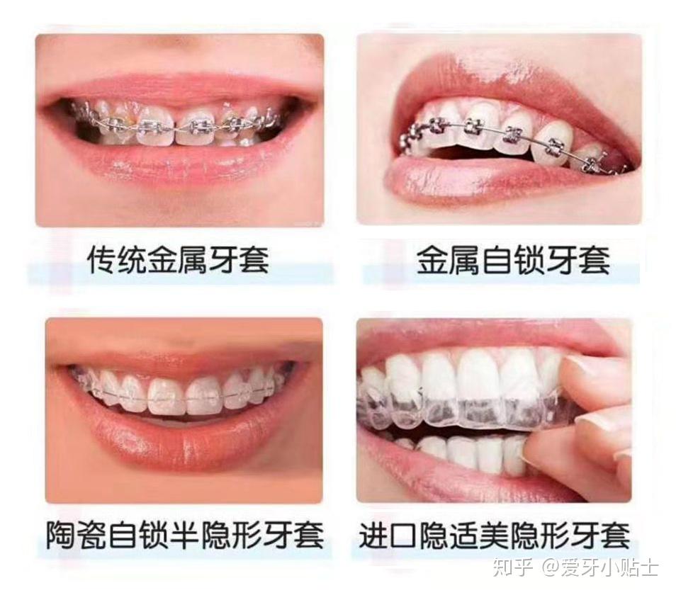 牙齿矫正了半年我为什么还没变化