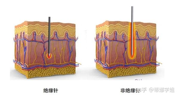 祛痘,缩毛孔,抗衰为啥都用黄金微针的?最全面的美容仪器它为什么好?黄金微针做前必读 - 知乎