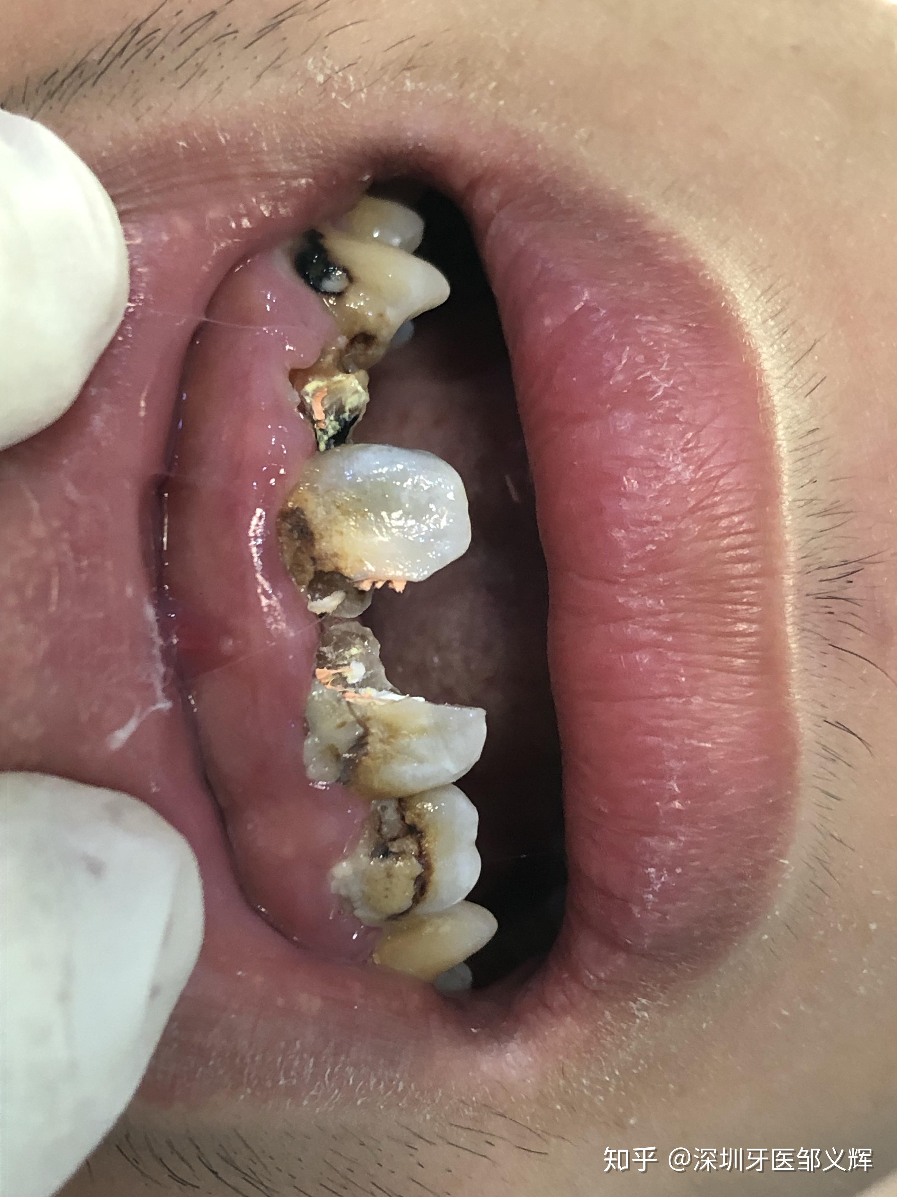 那些特别爱喝可乐的人他们的牙齿后来怎么样了