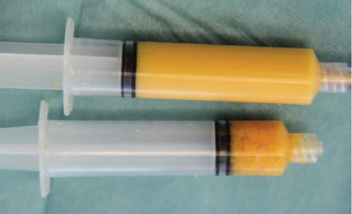 ECM/SVF-GEL：自体脂肪移植进入再生修复的2.0时代 - 知乎