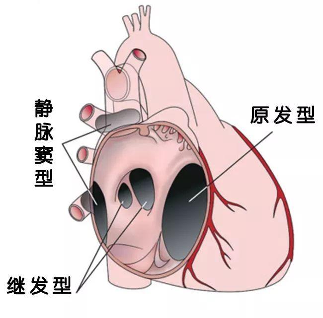 先心病房间隔缺损多大必须手术? - 知乎