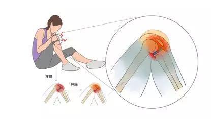 3分鐘瞭解膝蓋半月板撕裂
