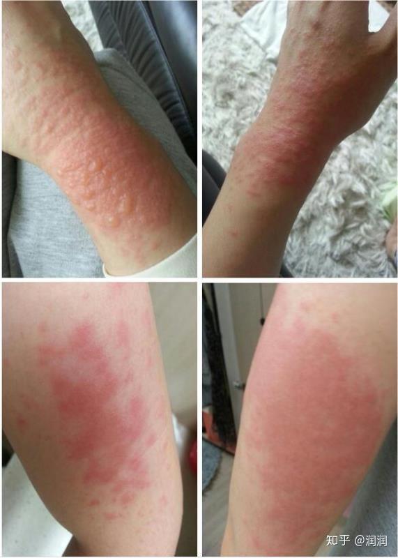 与紫外线过敏的抗争