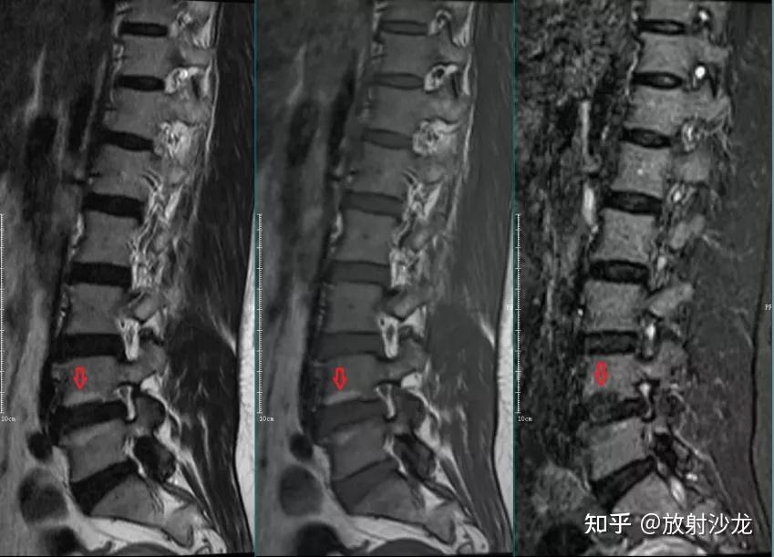 椎体终板炎 | 发生机制、分型以及 MRI 表现 - 知乎