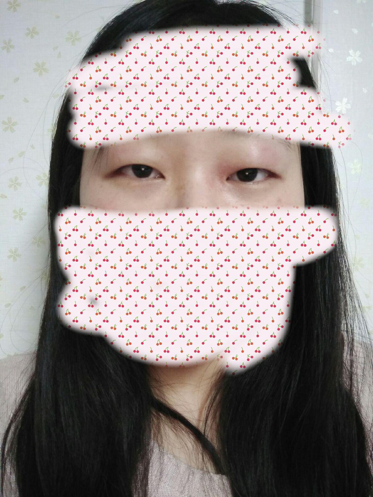 这个眼睛怎么做双眼皮啊,在武汉有推荐的吗,肿