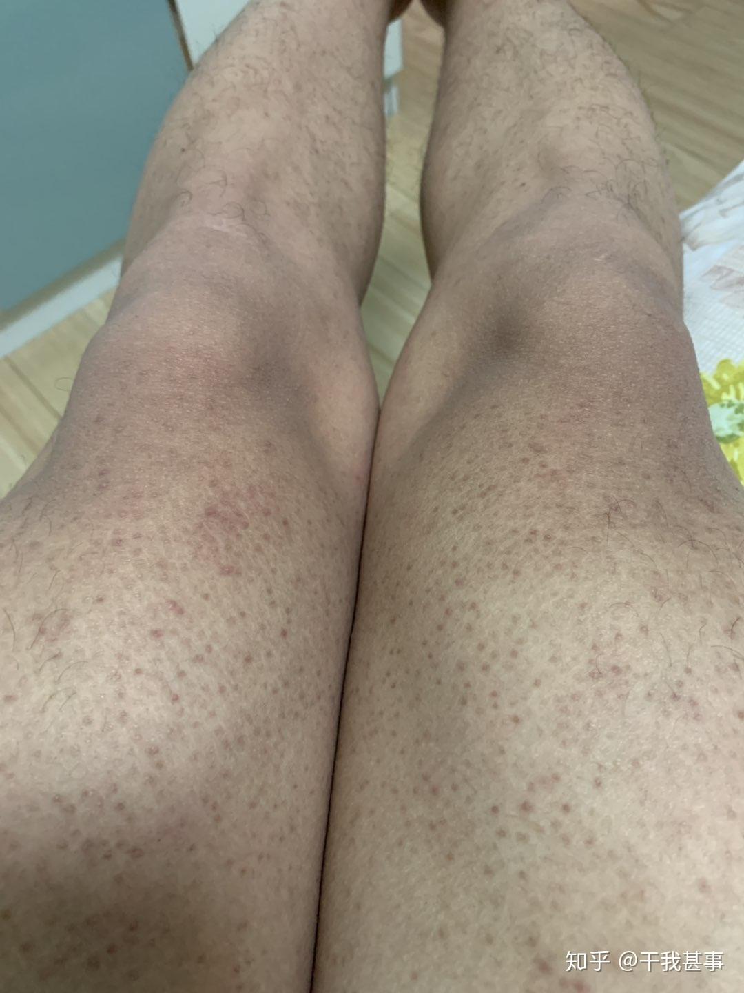 大家是怎样对待身上的鸡皮肤呢