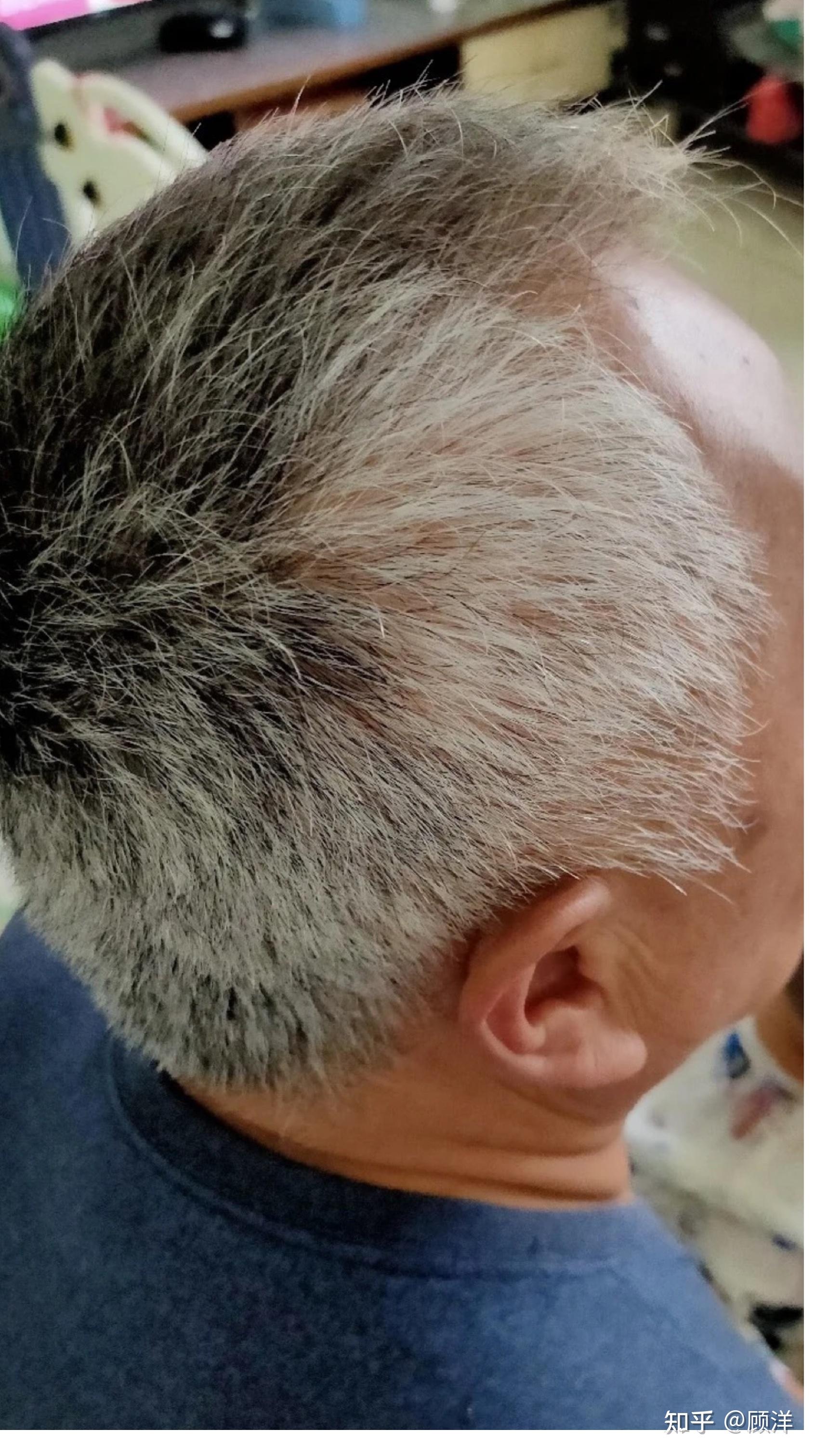 90后,压力大疯狂脱发,还一直长白头发,怎么办?有什么方法能够改善啊?