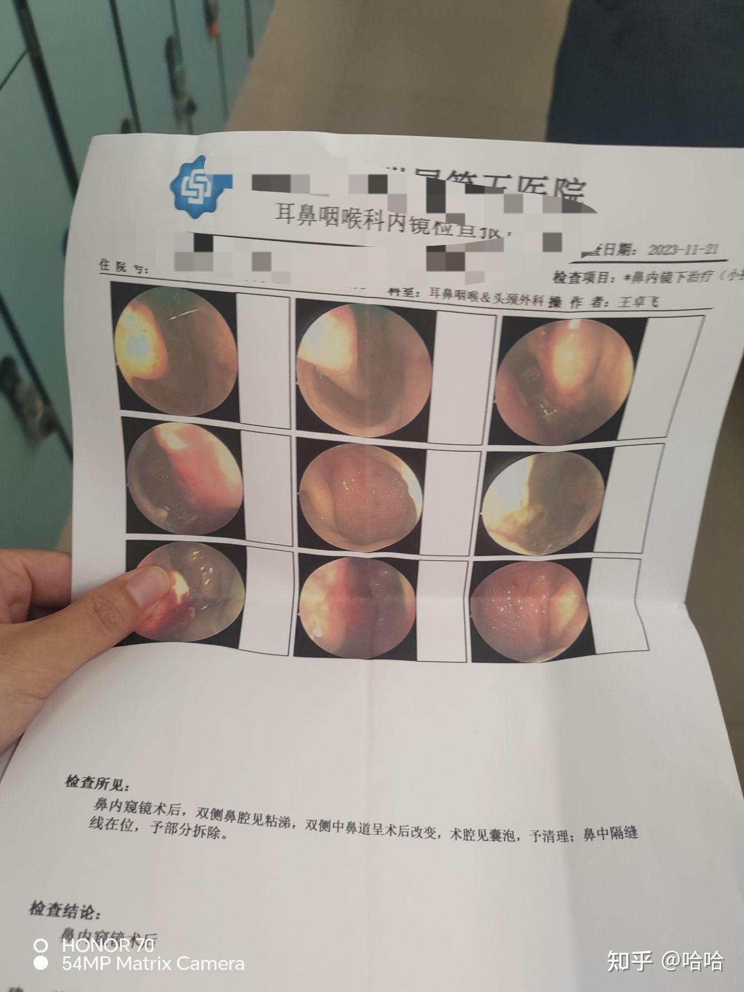 鼻息肉鼻窦炎术后六周了复查过程