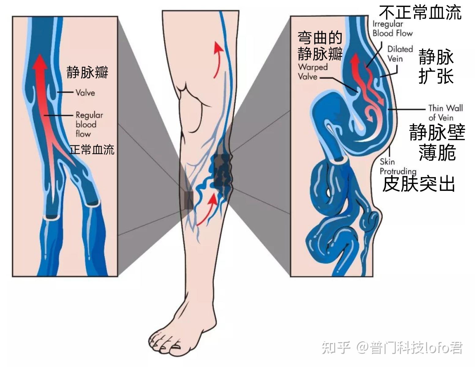 【静脉溃疡案例18】58岁保安大哥经常腿疼，以为是「风湿」|静脉曲张|案例|-健康界