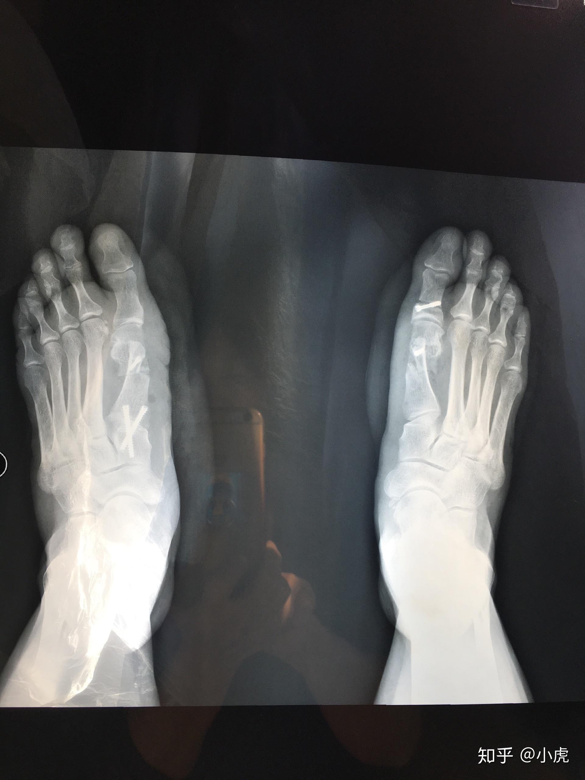 拇外翻手术五周结果让我惊喜和感动03