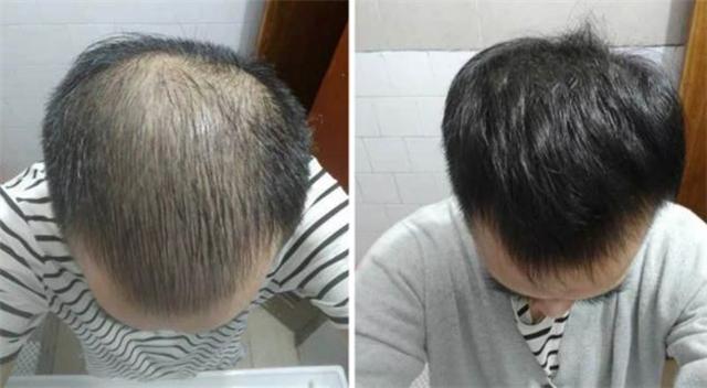 头顶头发越来越少怎么办