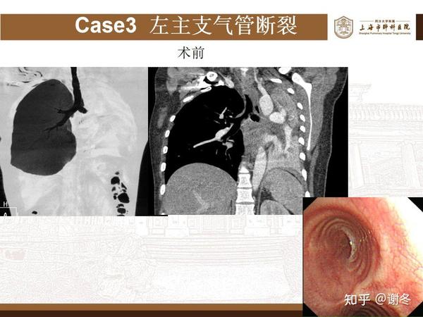 气管外伤、气管断裂——气管支气管裂伤是什么? 如何治疗? - 知乎