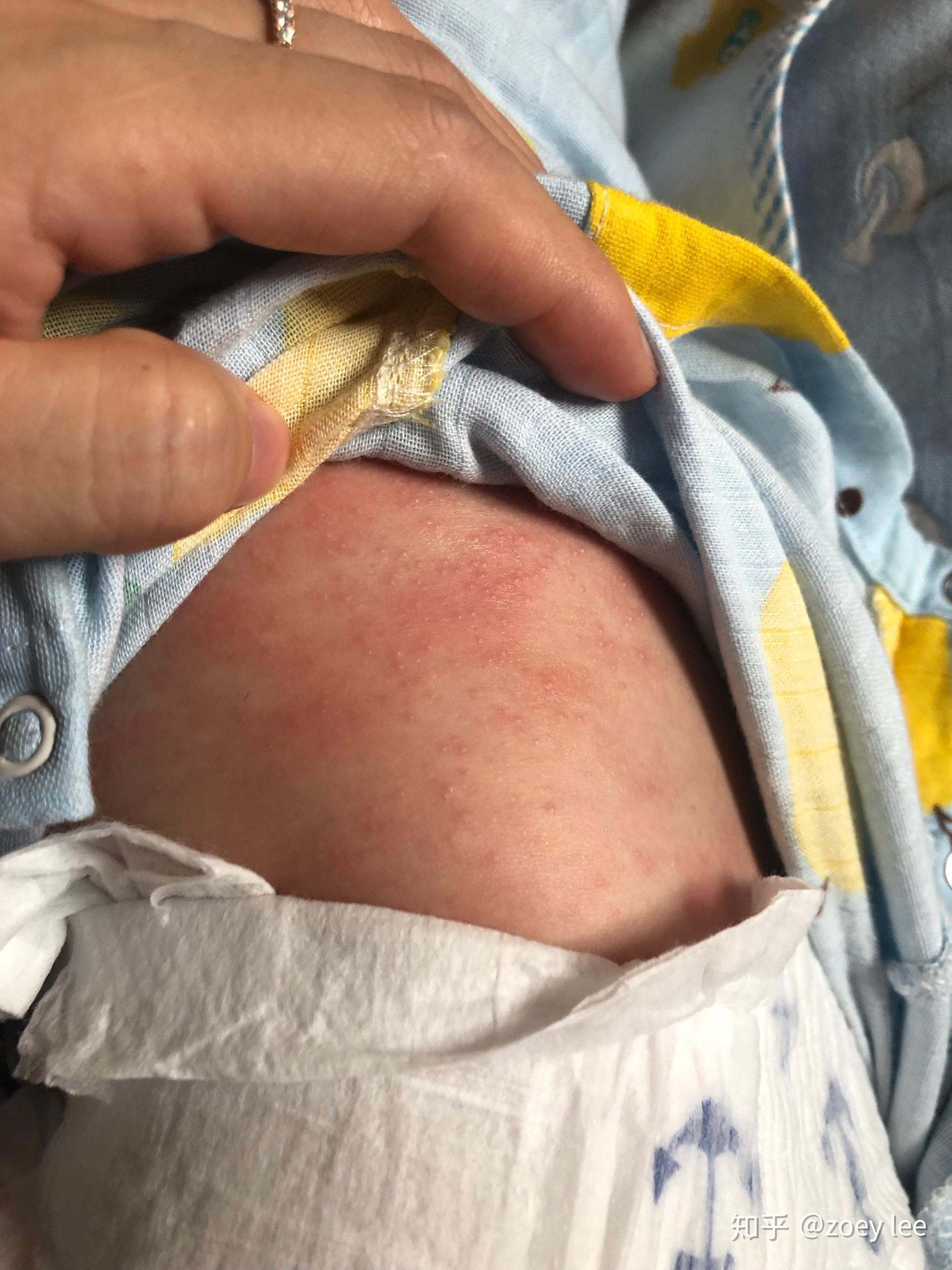 记录婴儿病毒性皮疹怀疑艾维诺燕麦润肤霜过敏导致的皮炎