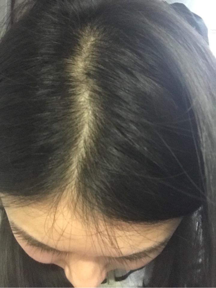 女生22,三年前发现头发越来越少,头发细软少,医