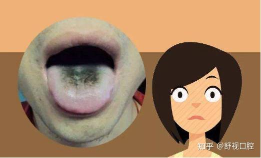 七,地图舌定义:一种发生在舌黏膜浅层的慢性边缘剥脱性舌炎.