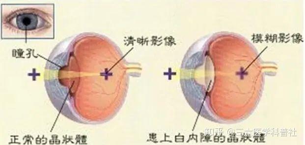 什么叫白内障白内障的初期症状 v2-9081559e0d26570872e39427e2630ff1_r.jpg