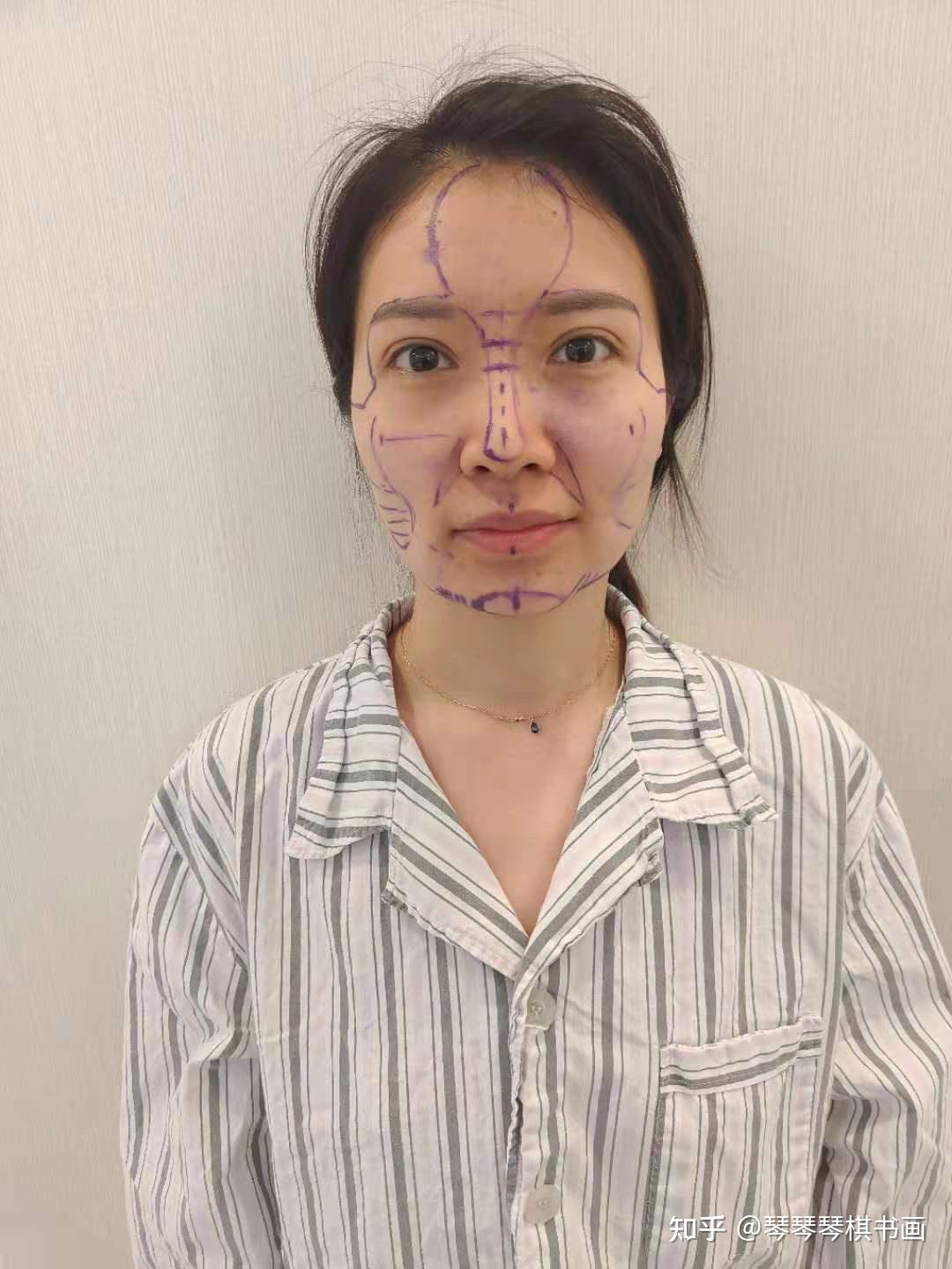 svf自体脂肪干细胞胶填充全脸手术过程记录