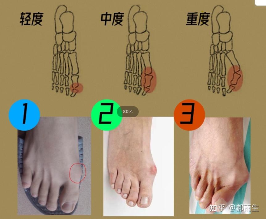 郝雨生解说，拇外翻的症状有哪些? - 知乎