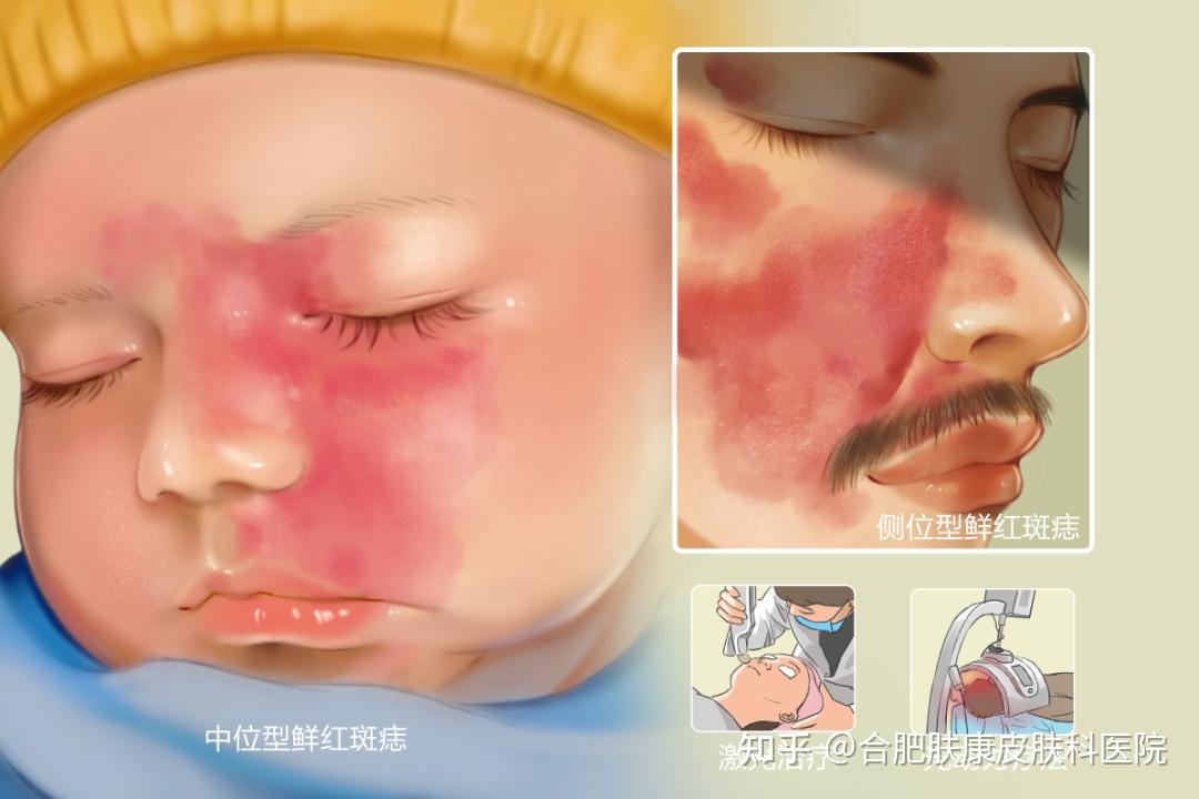 鲜红斑痣是怎么出现的能祛除吗