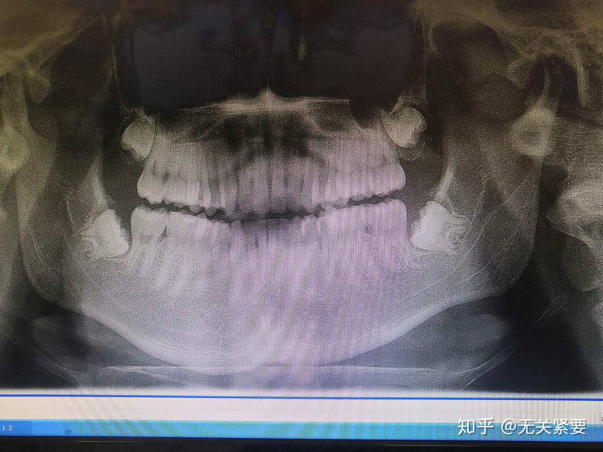 请问下牙的这种全埋伏智齿拔起来难度大么会不会影响神经什么的有图