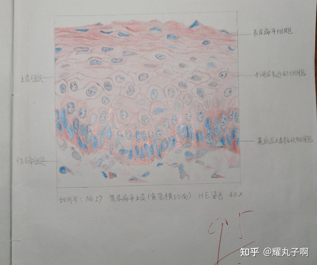 横纹肌萎缩手绘图图片