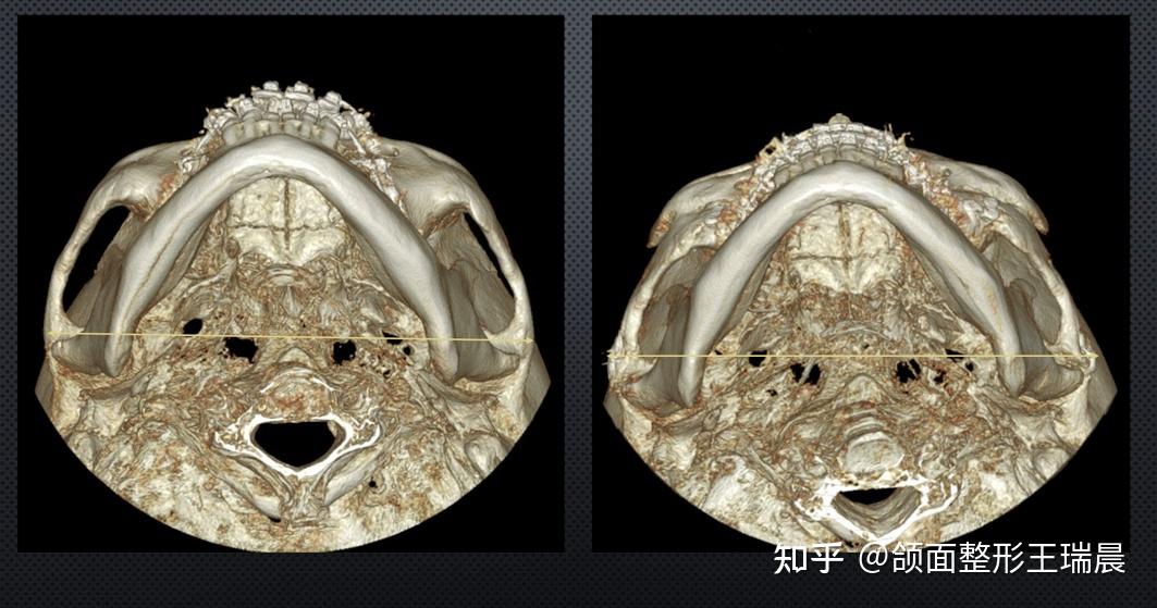 怎样知道颧骨内推手术有没有效果？ - 知乎