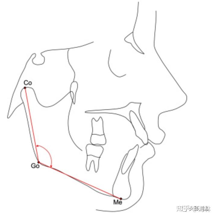 II类的治疗预测“神因子”---下颌角（Co-Go-Me）----下颌角越小，治疗后下颌前移越大 - 知乎