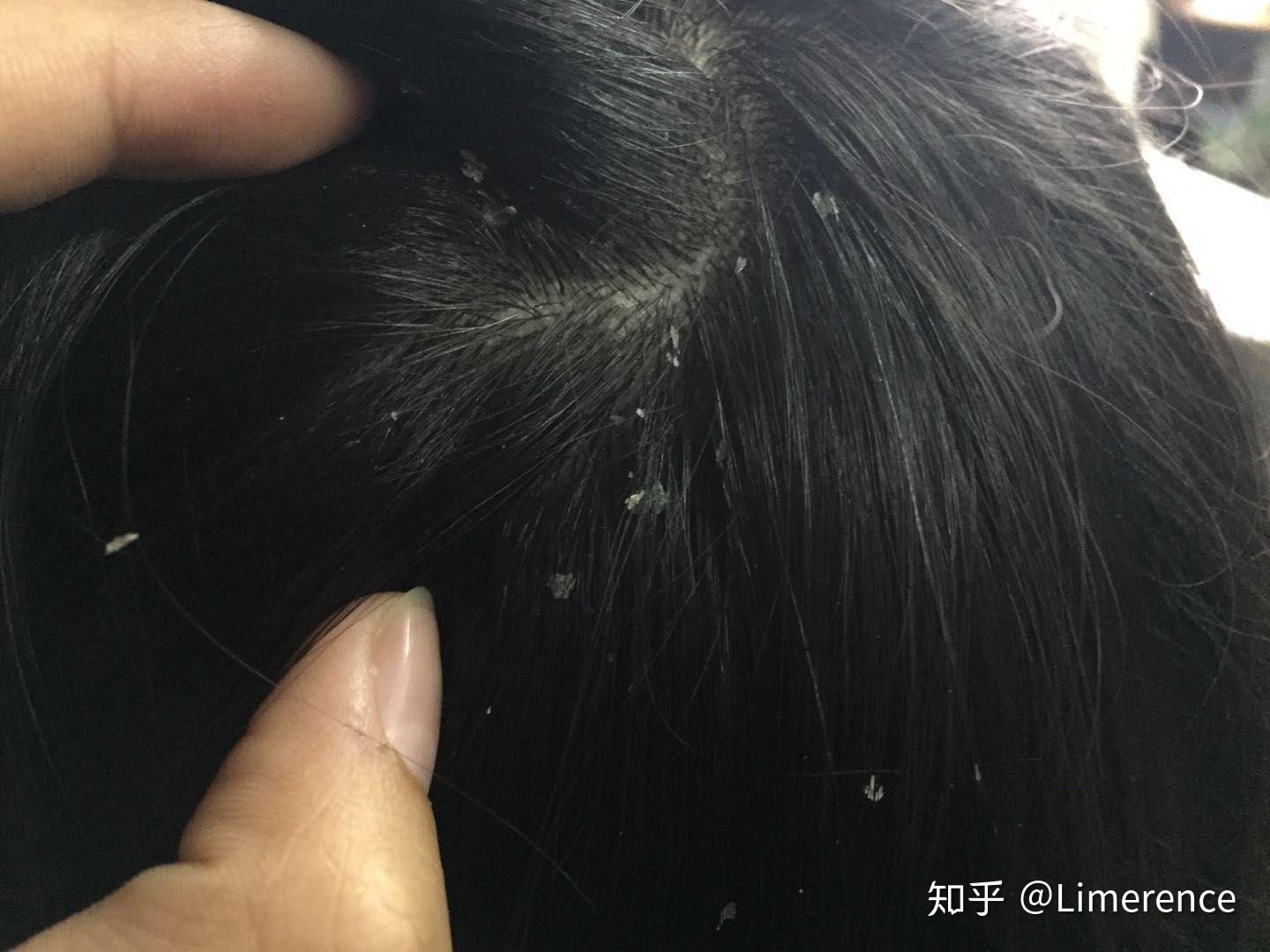 见过的最大头皮屑多大?