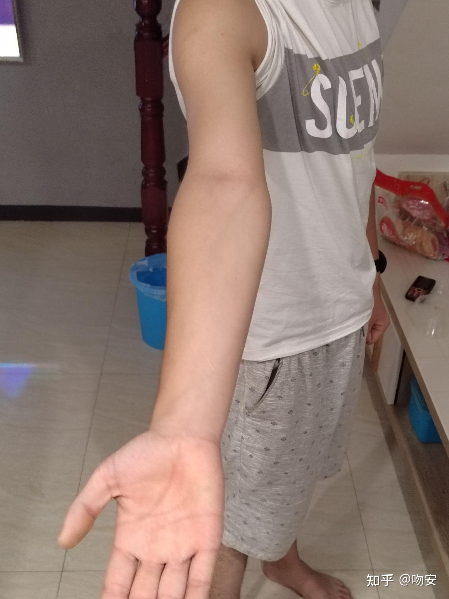 我想问一下我的这个算肘外翻吗军检有没有问题