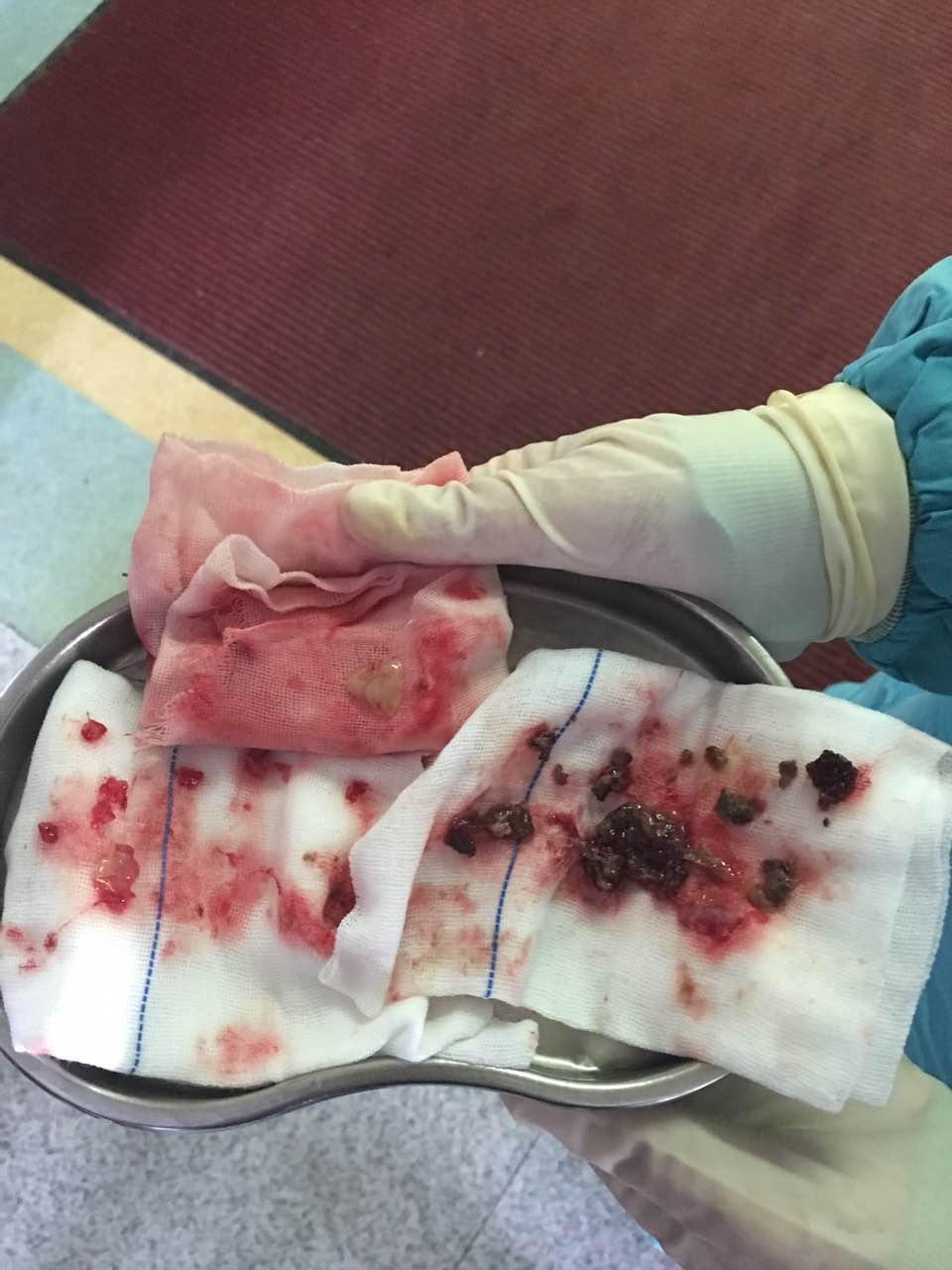 霉菌性鼻炎必须做手术吗