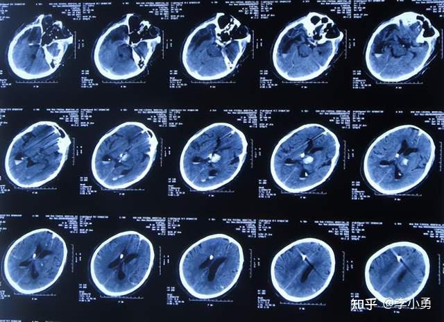 腦出血腦室外引流術後顱內感染腰大池引流術後加重感染高熱昏迷肢體