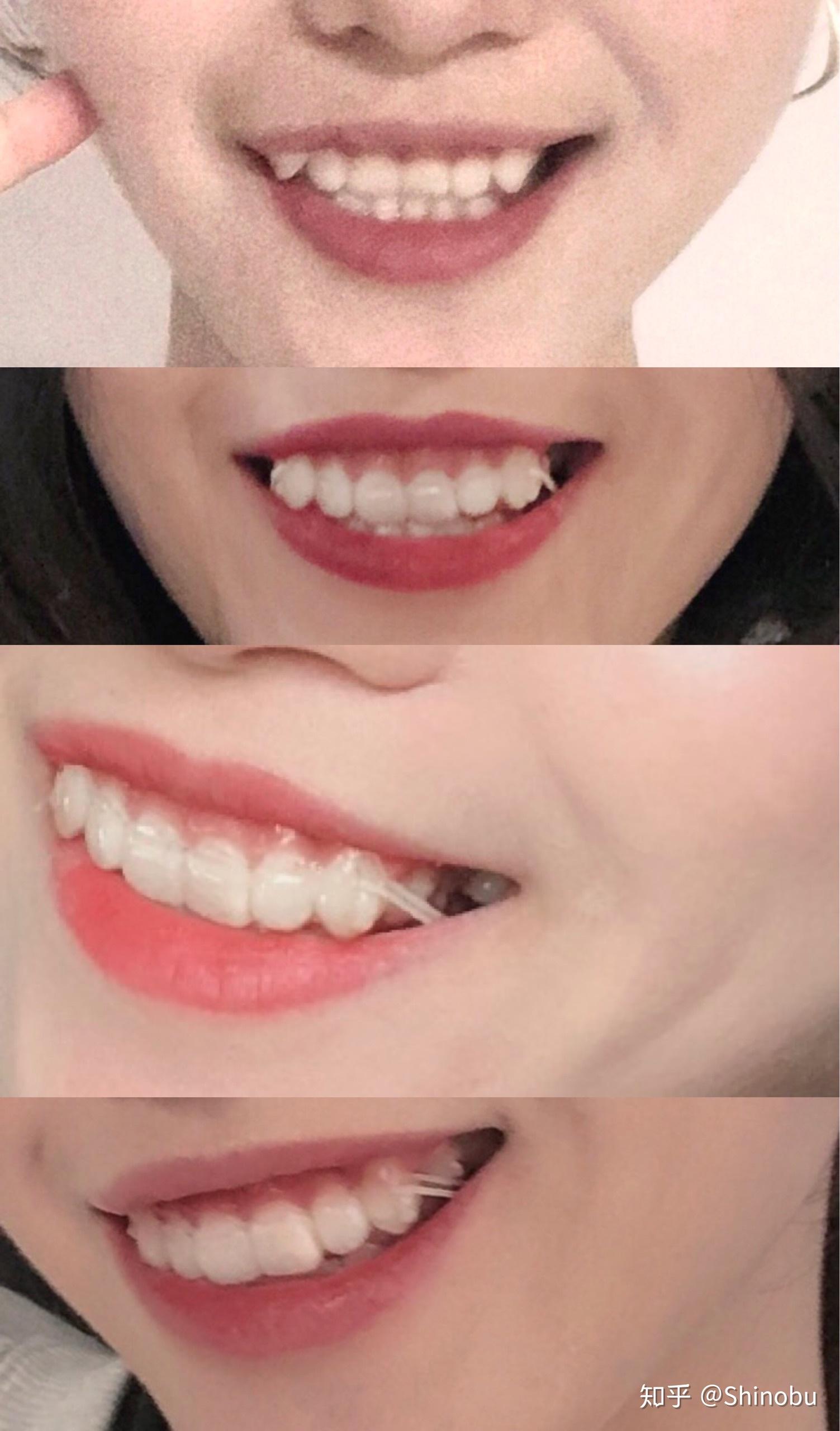 有没有内倾型深覆合的朋友请问脸型会变嘛