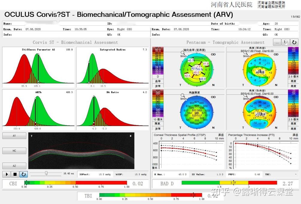圆锥角膜的RGP验配及RGP临床效果分析（文字版） - 知乎