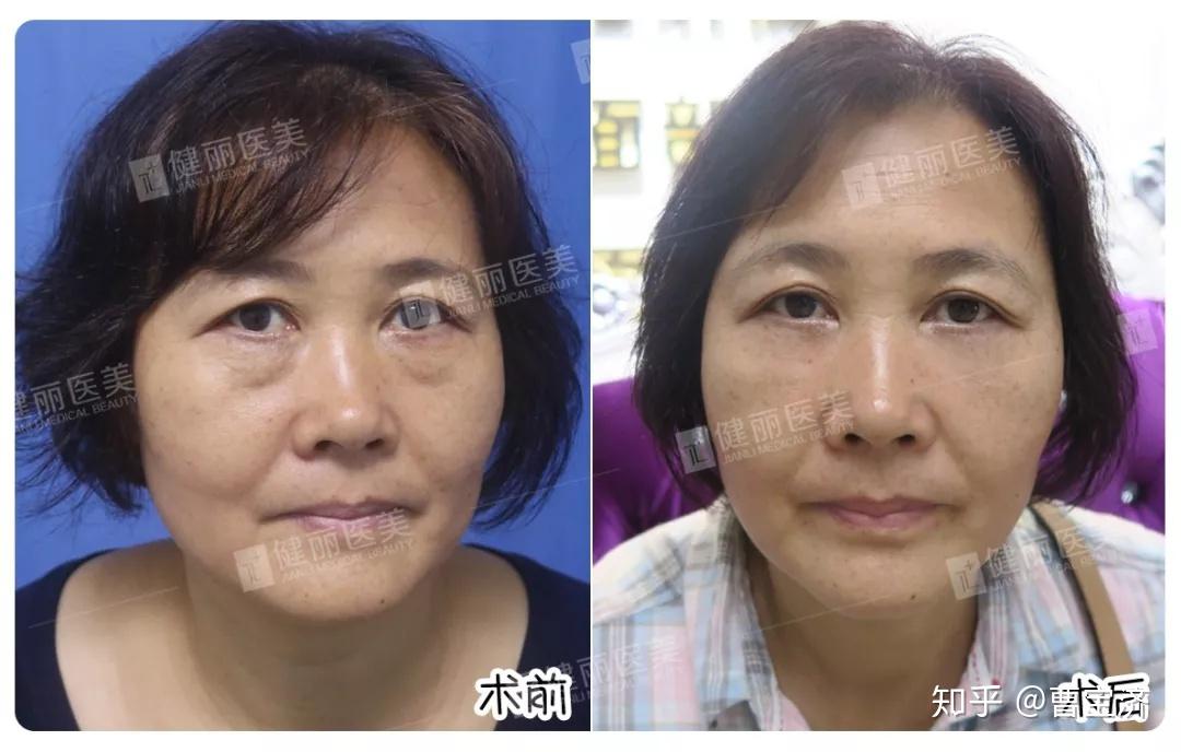 怎么很快去除眼袋 v2-910671d63d79738024de12b2acfdd755_r.jpg