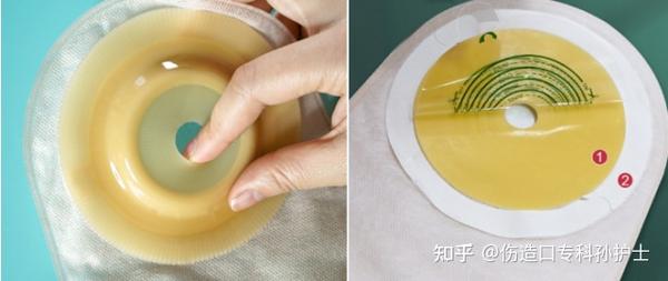 造口护理知识大全 - 知乎