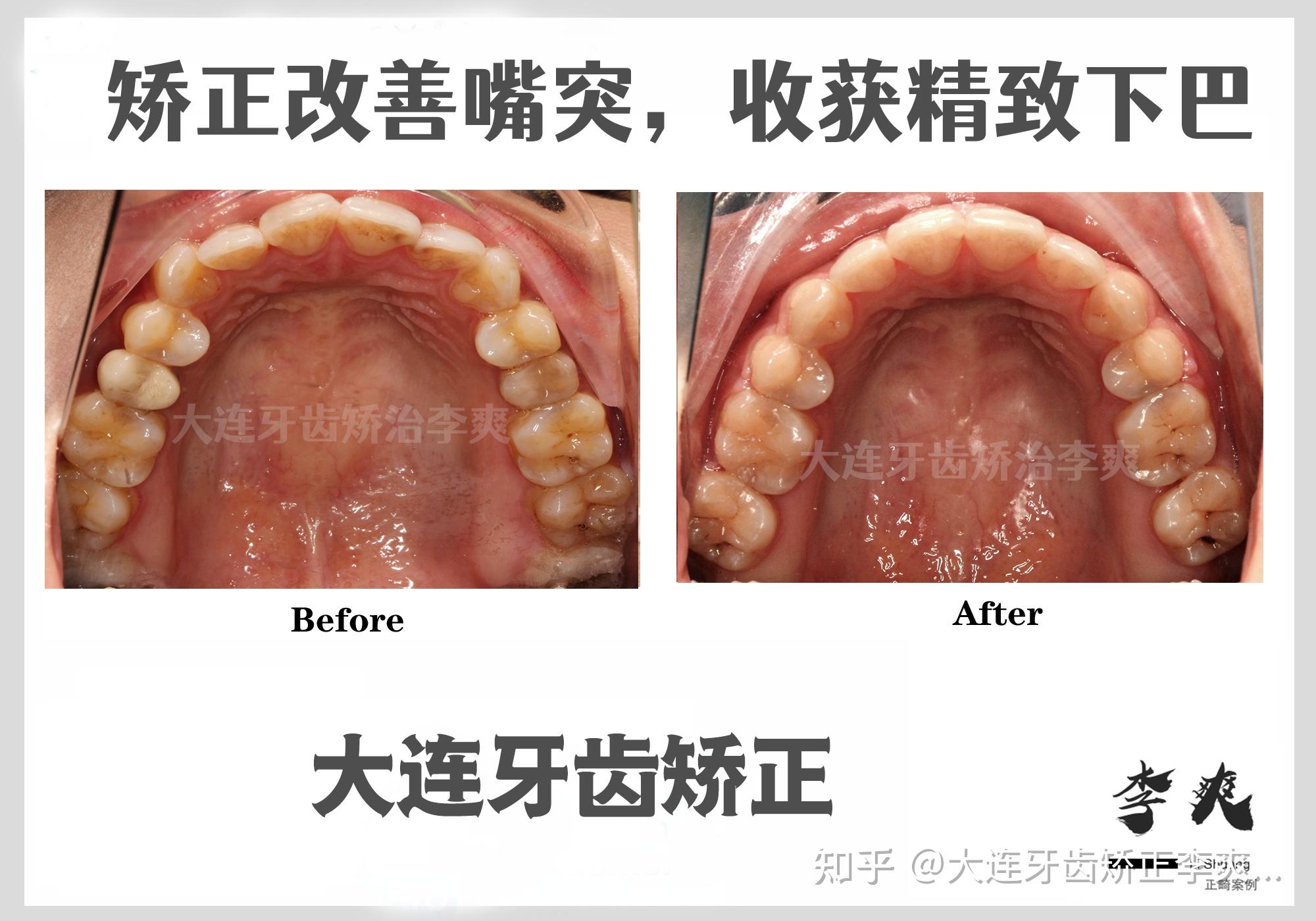 大連牙齒矯正丨正畸對突面型的改善有多大