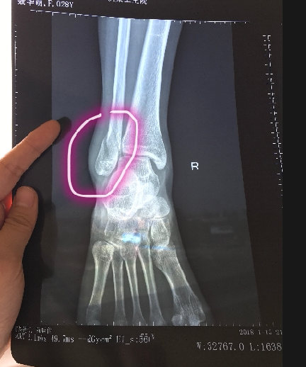 人生中第一次手术 脚踝腓骨骨折手术 知乎 人生中第一次手术 脚踝腓骨骨折手术 知乎