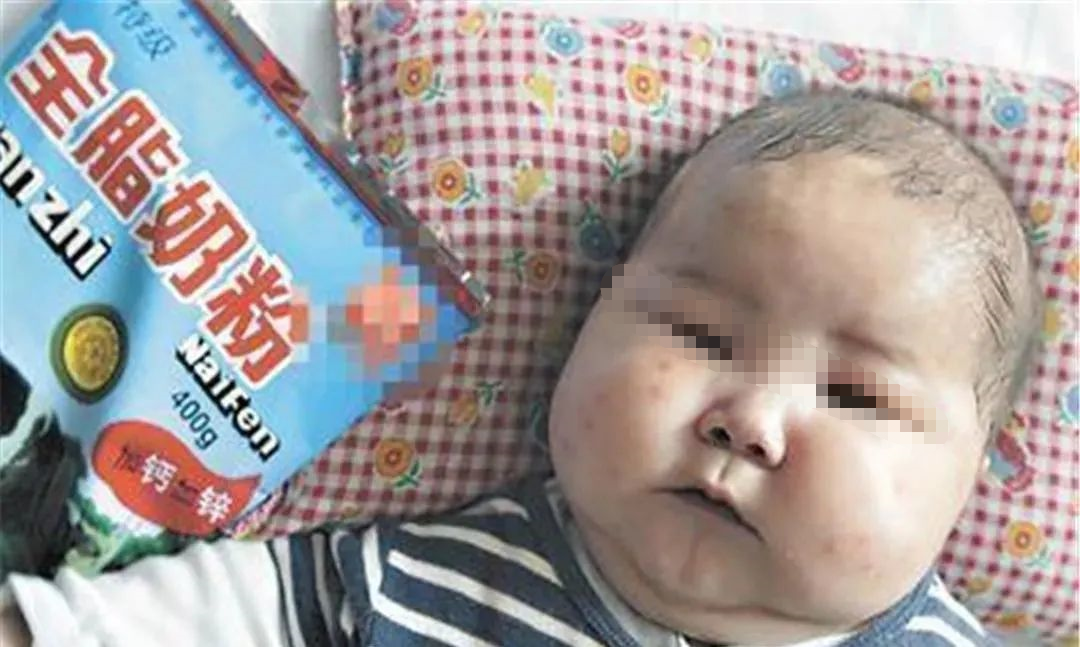 震惊全国的三鹿奶粉事件已经14年了那30万被三聚氰胺毒害的大头娃娃