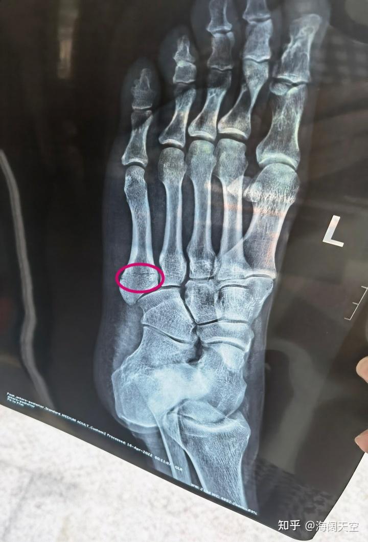 左脚第五跖骨骨裂图片图片