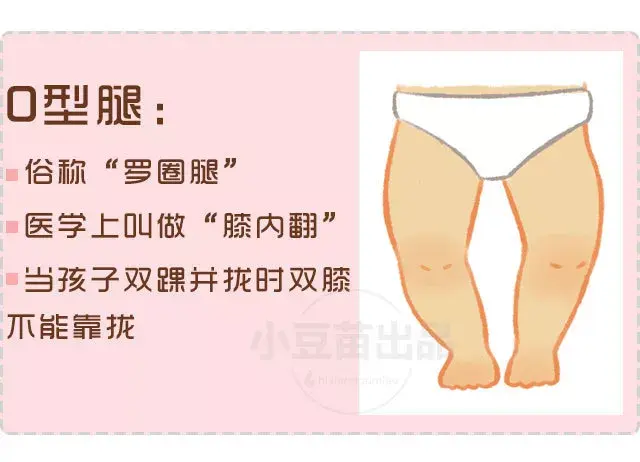 o型腿 ,就是我们平时说的"罗圈腿",在医学上叫做"膝内翻",外在表现是