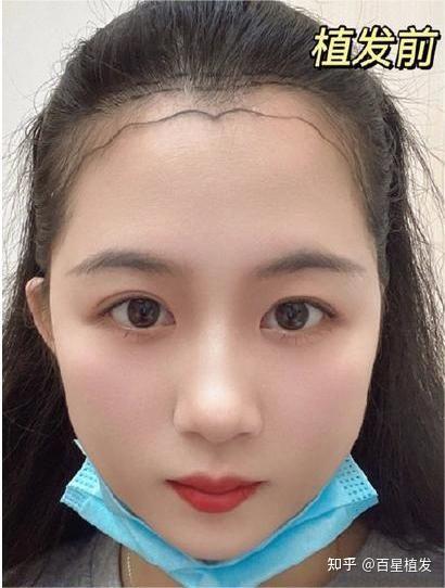 百星植发|王女士的变美之路 - 知乎