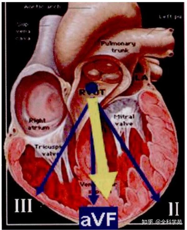 心电图笔记37：室性心律失常起源的心电图定位 - 知乎